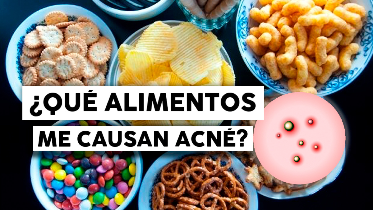 10 Alimentos que DEBES EVITAR para combatir el ACNÉ