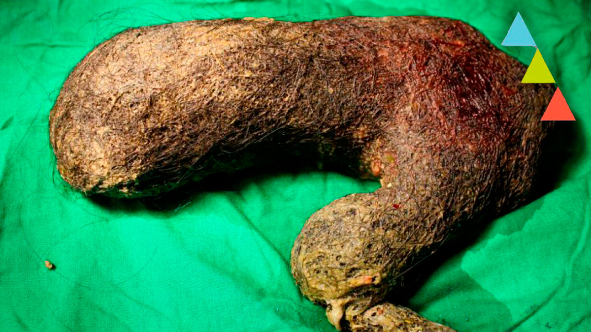 10 enfermedades muy raras que desearás no tener